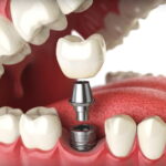 Dental implants cost near me