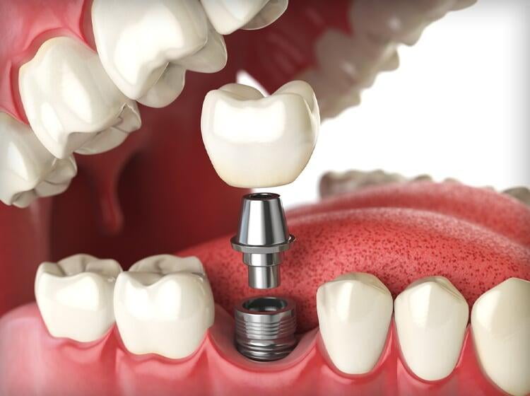 Understanding the Dental Implant Treatment Process in Palmdale