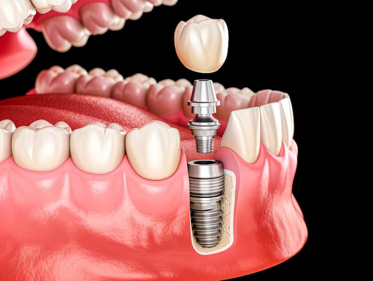 Dental implants in Palmdale