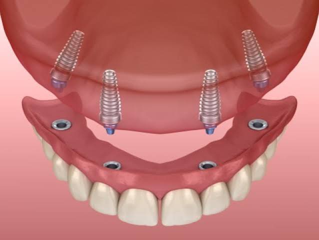 Implant dentist Palmdale